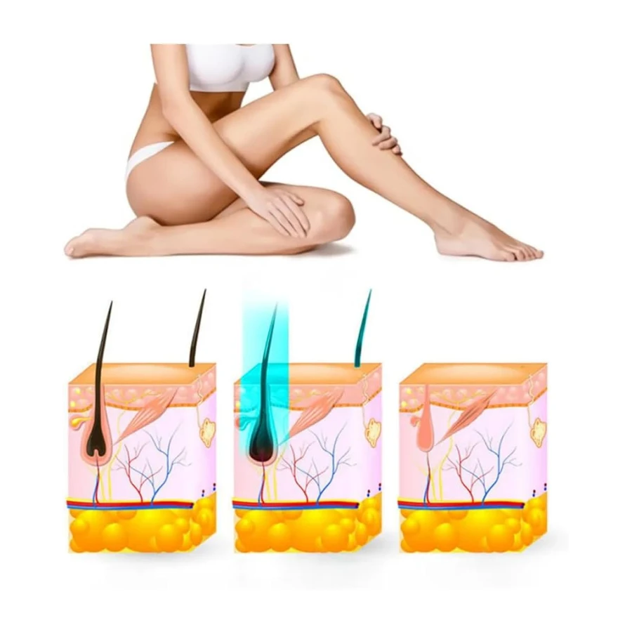 Yui Iplv15 Pro Vücut -Yüz- Bikini Başlıklı Ağrısız Otomatik Ve Manuel Atım Buz Lazer Epilasyon Cihazı Siyah